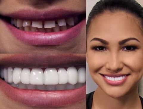 Perfect Smile Teeth Veneers