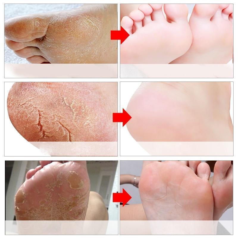 Baby Feet Exfoliation Foot Peel