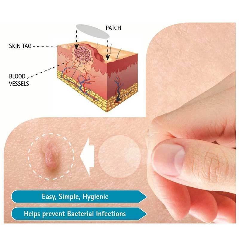 Skin Mole Removal Patch